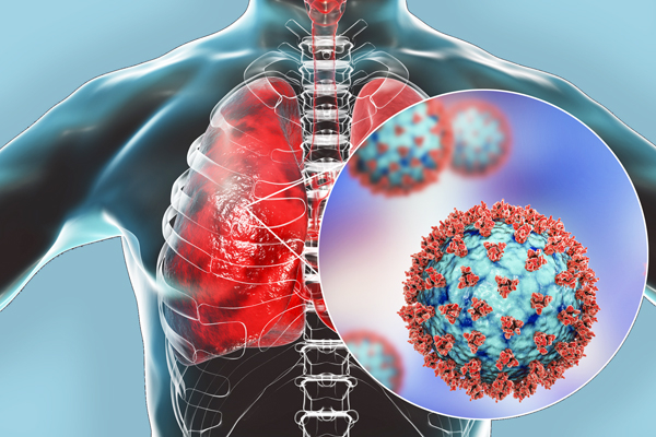 Коронавирусная (ковидная) пневмония