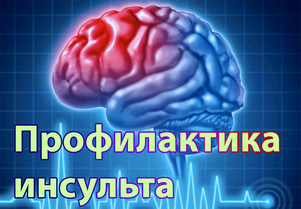 Профилактика инсульта