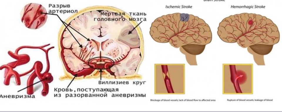  Инсульт 